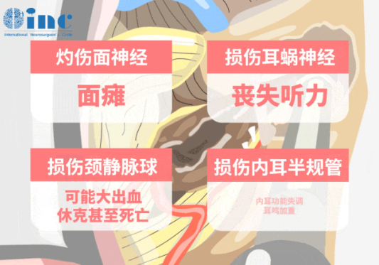 內(nèi)聽道磨除術(shù)及修補術(shù)