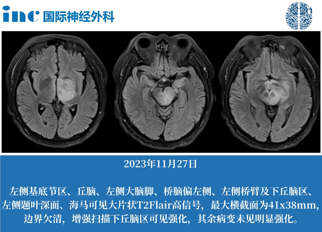 59歲疑難神外疾病患者，不出國(guó)門，如何咨詢國(guó)際腦干教授