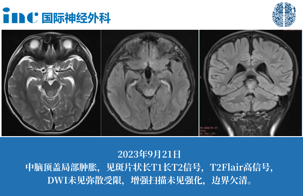 7歲男孩腦干中腦病變，巴教授能否可以手術(shù)？手術(shù)時(shí)機(jī)是何時(shí)？