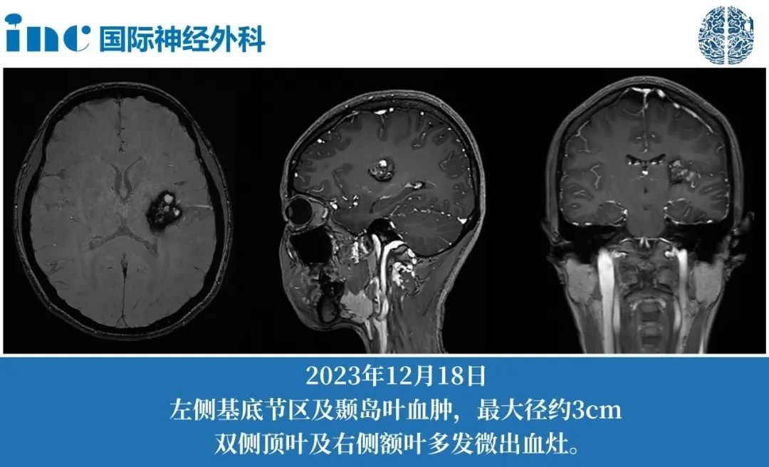 26歲女性基底節(jié)海綿狀血管瘤2次出血，癥狀加重，這次該如何應(yīng)對(duì)？