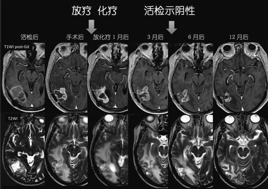 假性進展病例:患者男性,59歲,活檢報告膠質(zhì)母細胞瘤,替莫唑胺同步放化療1個月后出現(xiàn)磁共振増強范圍擴大,6個月后逐漸消退