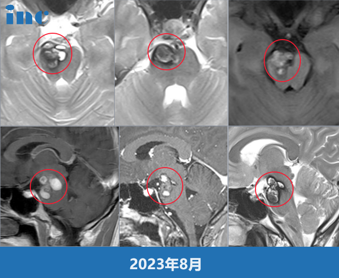 腦干海綿狀血管瘤