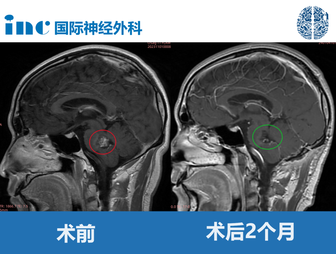 30歲男性-腦干海綿狀血管瘤，可以順利全切、無并發(fā)癥嗎？