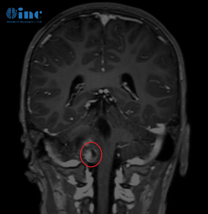 兒童腦腫瘤