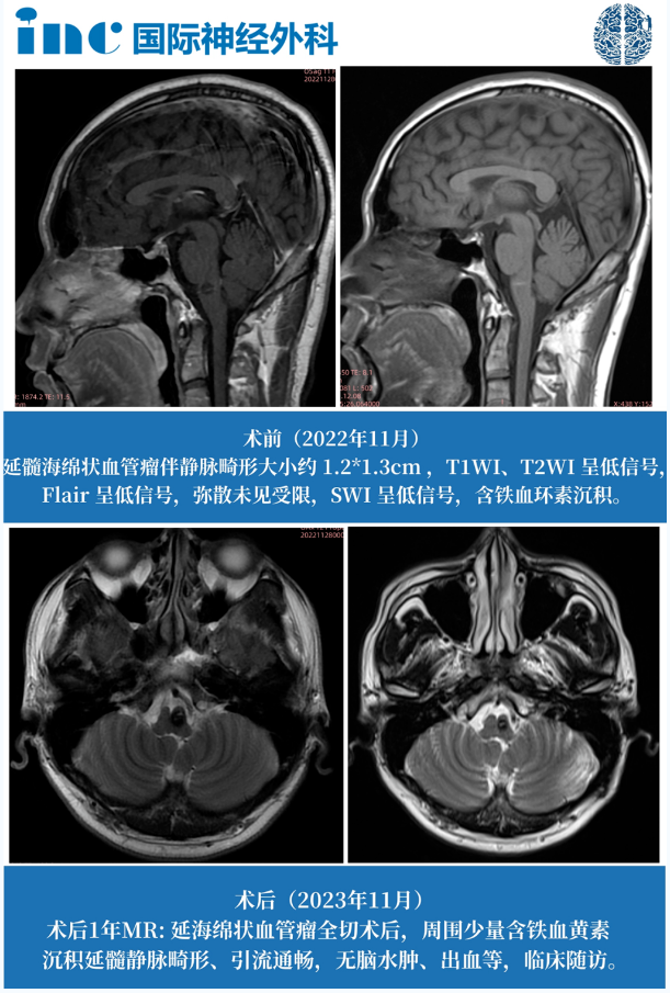 腦干海綿狀血管瘤伽馬刀治療合適嗎？