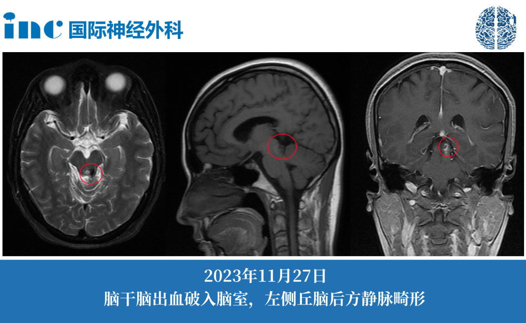 海綿狀血管瘤？靜脈畸形？毛細血管擴張？