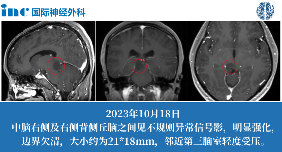 茵茵34歲女性-中腦占位性病變