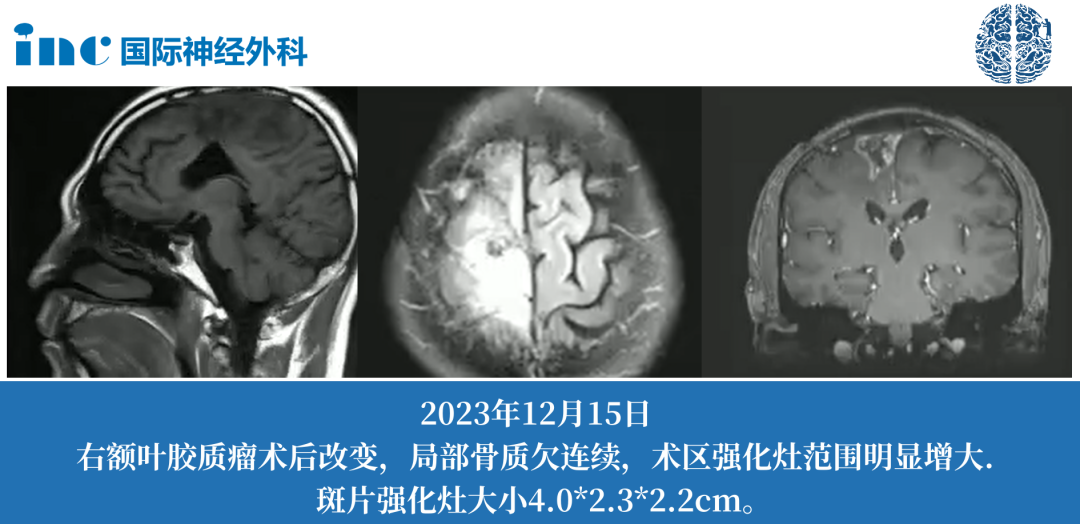 唐先生45歲男性-右額膠質(zhì)母細(xì)胞瘤
