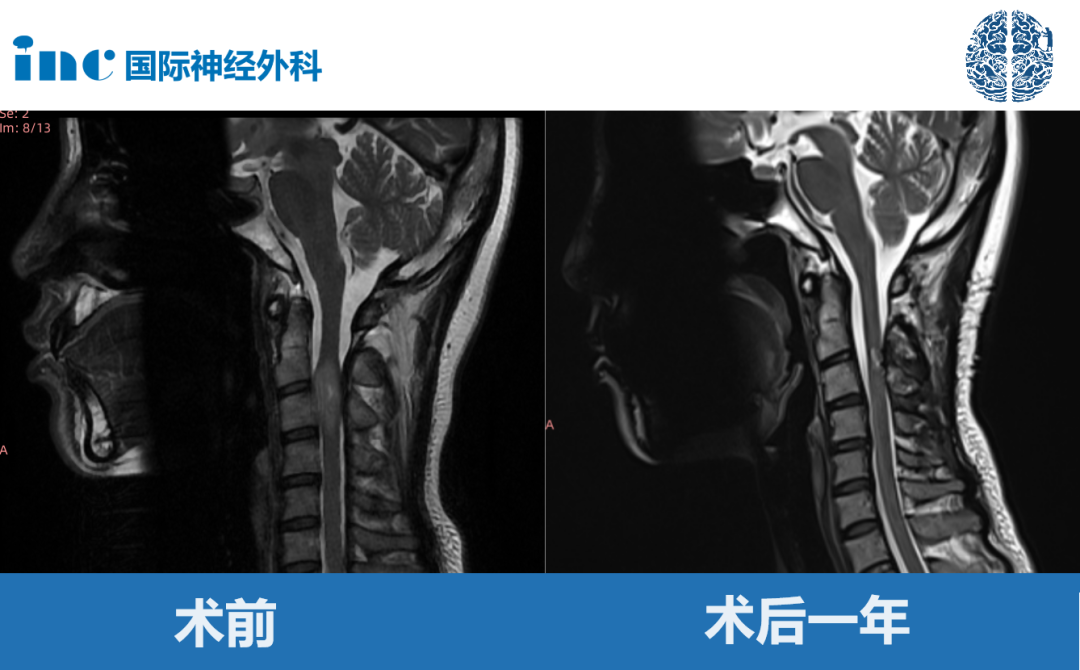 高位脊髓腫瘤真實(shí)案例