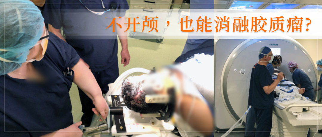 <a href='/jiaozhiliu/' target='_blank'><u>膠質(zhì)瘤</u></a>復(fù)發(fā)可以不開顱手術(shù)嗎