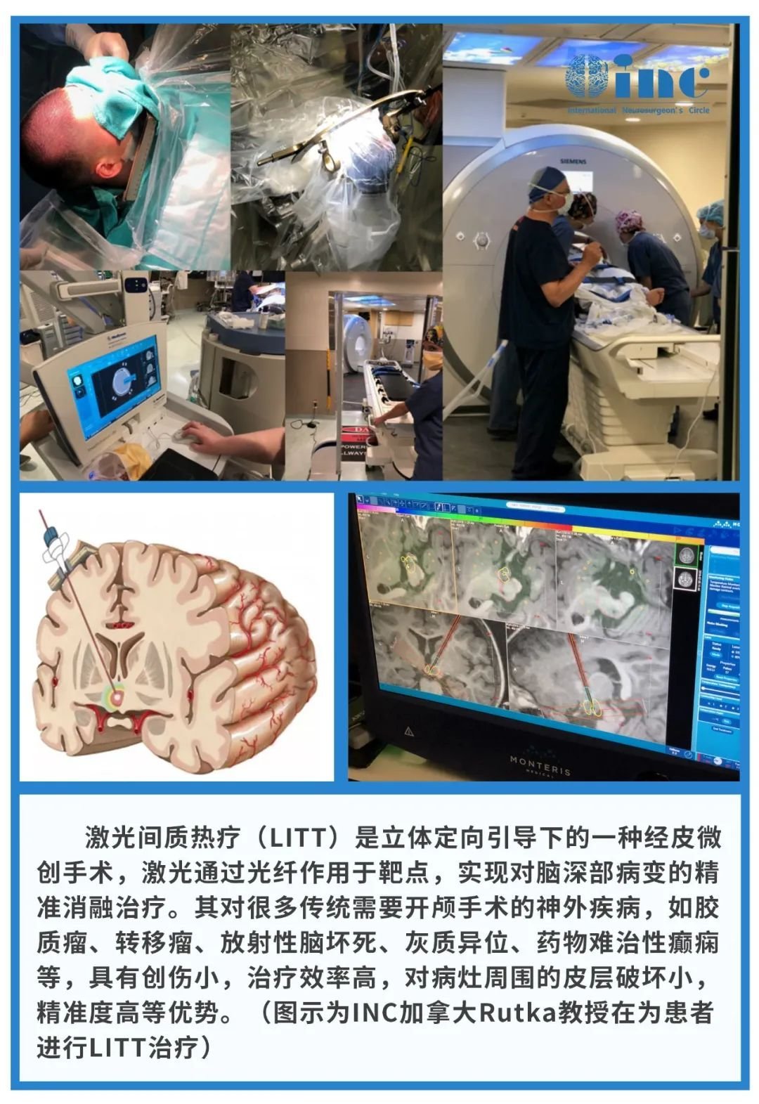 膠質(zhì)瘤復(fù)發(fā)可以不開顱手術(shù)嗎