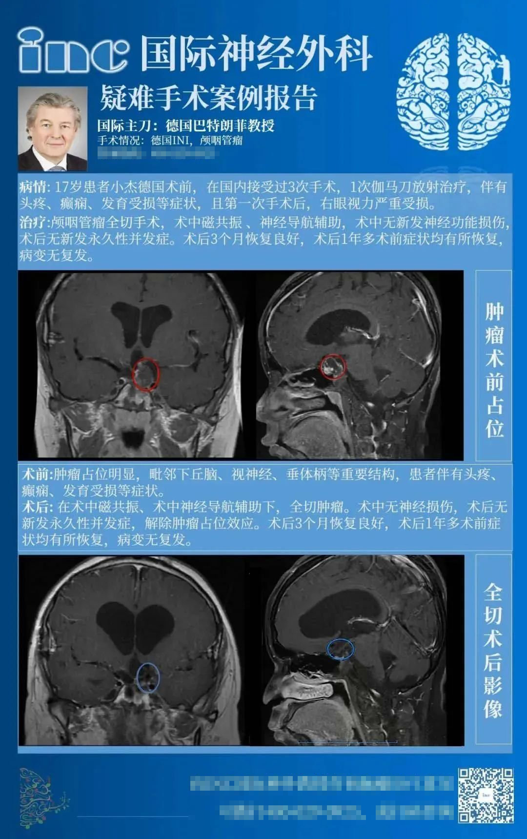 18歲男孩顱咽管瘤16年3次復(fù)發(fā)，癲癇、發(fā)育遲滯