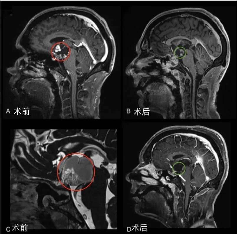 圖1后視交叉性較大顱咽管瘤患者腫瘤術(shù)前（A，C）和術(shù)后（B,D）矢狀位增強(qiáng)MR對(duì)比，顯示腫瘤全切。