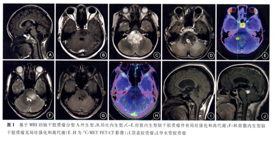 圖1.基于MRI的腦干膠質(zhì)瘤分型A.外生型；B.局灶內(nèi)生型；C-E.彌散內(nèi)生型腦干膠質(zhì)瘤伴有局灶強(qiáng)化和高代謝；F-H.彌散內(nèi)生型腦干膠質(zhì)瘤無局灶強(qiáng)化和高代謝（C、H為11C-METPET-CT影像）；I.頂蓋膠質(zhì)瘤；J.導(dǎo)水管膠質(zhì)瘤.不同型治療或預(yù)后會(huì)有差別。圖自腦干膠質(zhì)瘤咨詢共識(shí)