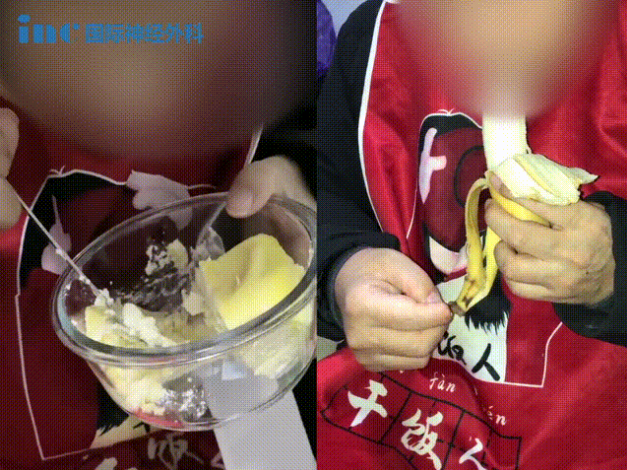48歲男性較大脊索瘤5年內4次復發(fā)3次手術