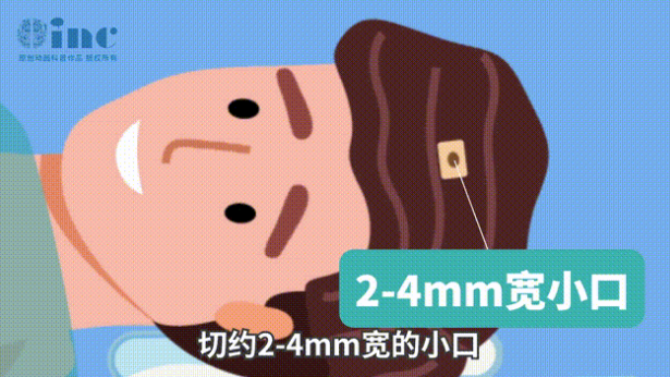 手術(shù)僅需在患處頭皮上切約2-4mm寬的小口插入激光光纖探頭至病灶所在位置利用脈沖激光消融腫瘤及病變組織。