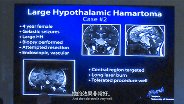 四歲女童深受癡笑樣癲癇困擾  　　LITT技術(shù)消融元兇下丘腦錯構(gòu)瘤