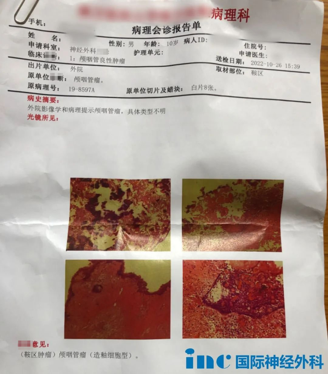 顱咽管瘤復(fù)發(fā)？需要手術(shù)嗎？