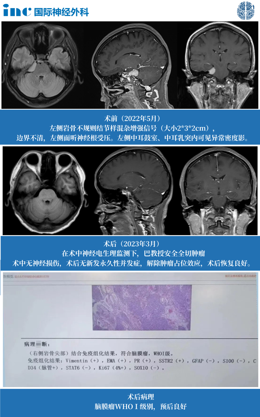 腦膜瘤伽馬刀好還是手術(shù)好