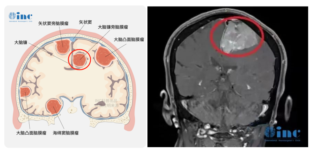 疑難位置腦膜瘤能切干凈嗎——案例