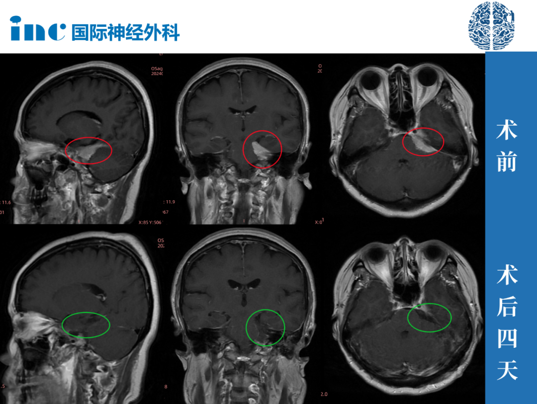 這次手術(shù)距離剛查出來腦膜瘤已經(jīng)有半年多之久，先前的醫(yī)生均表示：手術(shù)風(fēng)險很大，造成視力、視野缺損等后遺癥，而且如果腫瘤切不干凈較有可能復(fù)發(fā)。