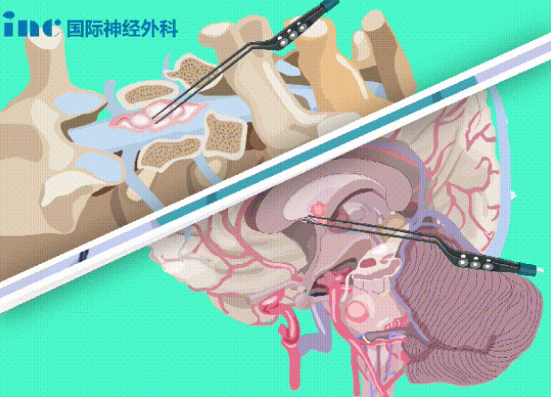 雙較電凝是什么？