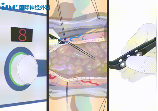 雙較電凝是什么？
