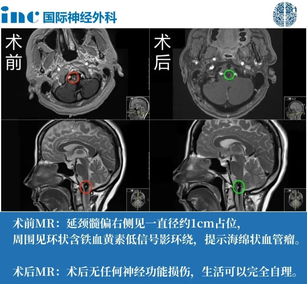 高位頸髓海綿狀血管瘤