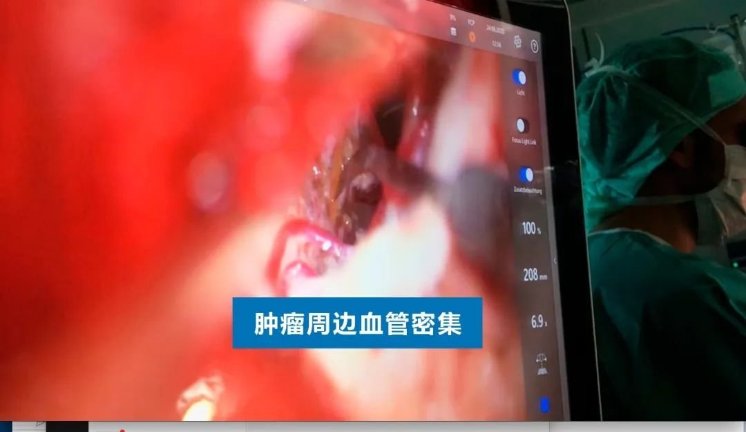 INC德國(guó)巴特朗菲教授手術(shù)實(shí)拍
