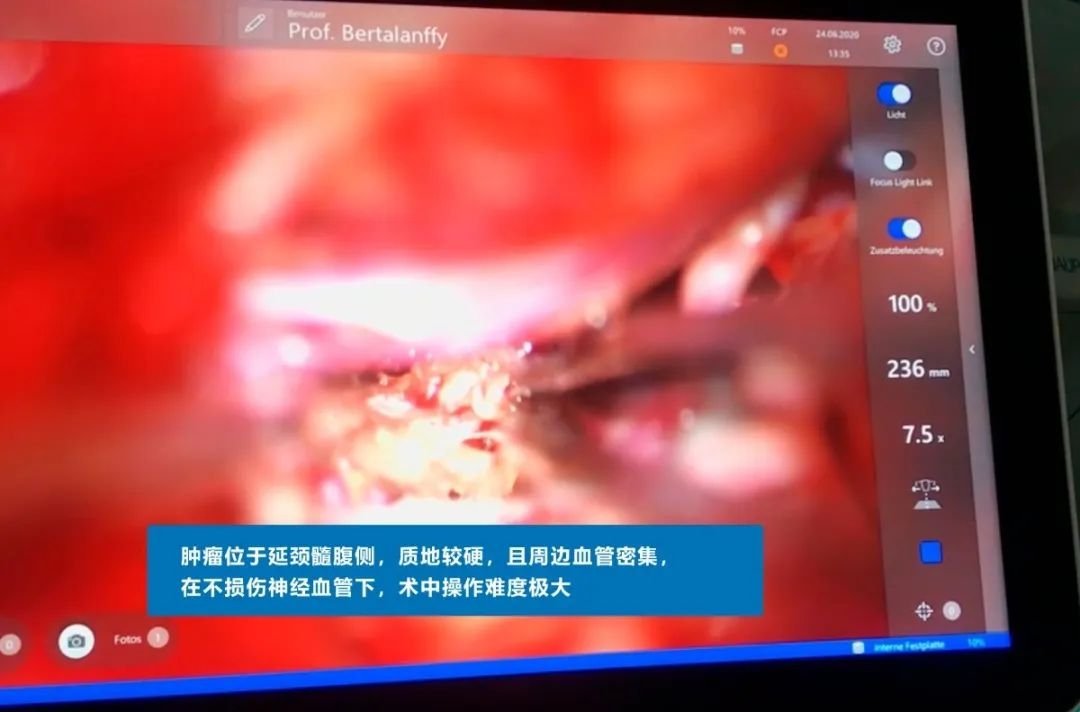 INC德國(guó)巴特朗菲教授手術(shù)實(shí)拍