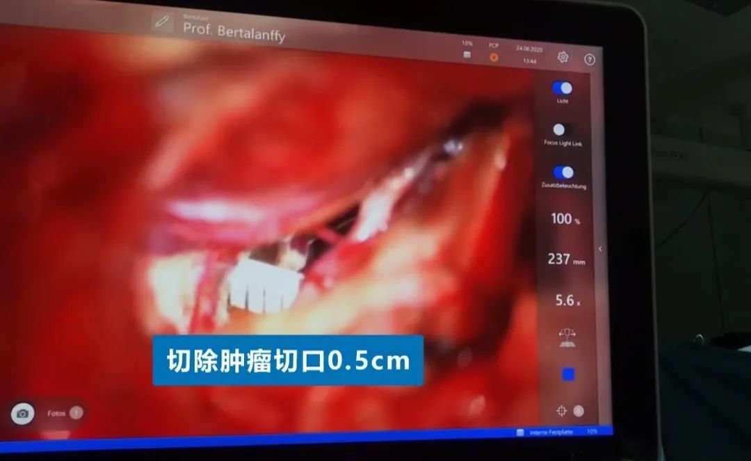 INC德國(guó)巴特朗菲教授手術(shù)實(shí)拍