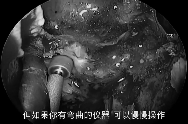如果你有彎曲的儀器可以慢慢操作，因為脊索瘤是軟的，這也是脊索瘤的特點之一。