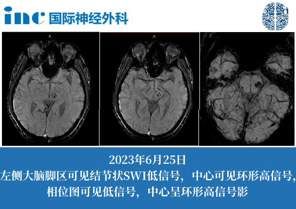 18歲男孩-腦干海綿狀血管瘤