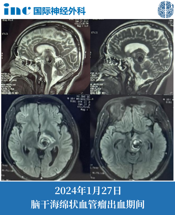 18歲男孩-腦干海綿狀血管瘤
