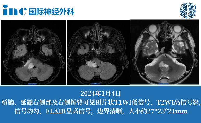 36歲男性-橋腦、延髓右側(cè)及右側(cè)橋臂占位