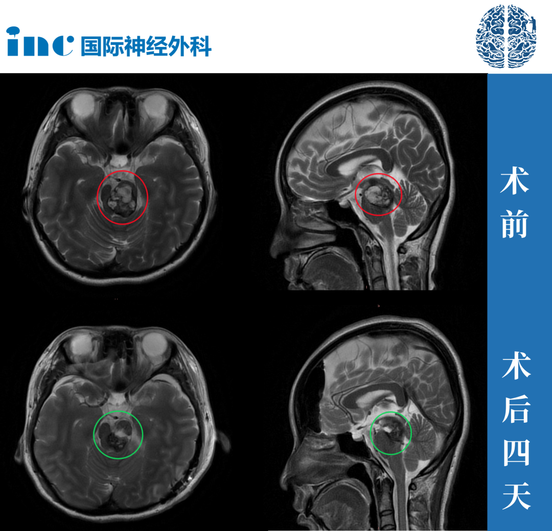 腦干海綿狀血管瘤案例