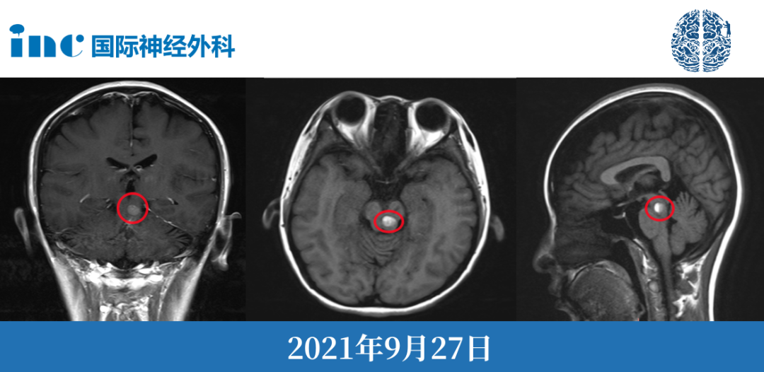 放療真的可以治療腦干海綿狀血管瘤嗎？