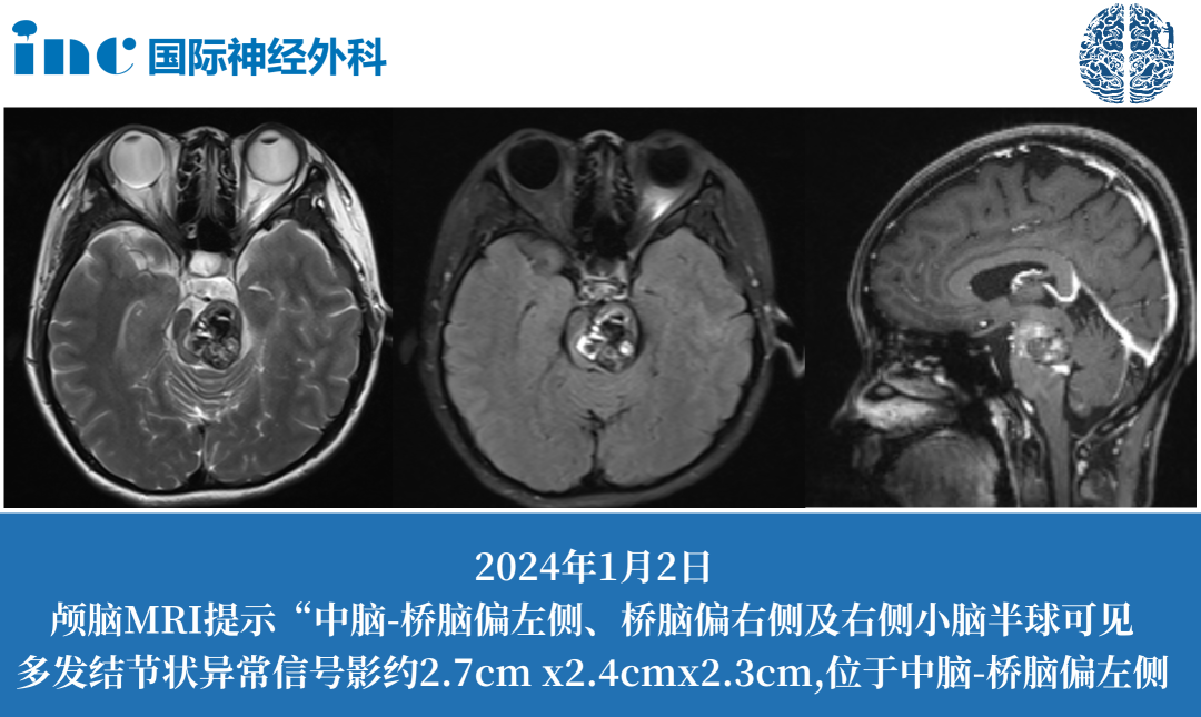 治療腦干海綿狀血管瘤