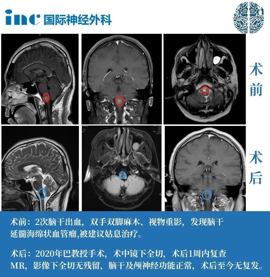腦干-延髓海綿狀血管瘤案例