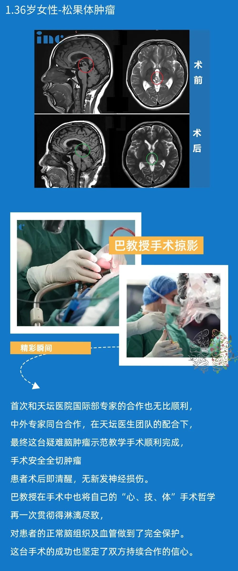 巴特朗菲教授北京天壇手術(shù)