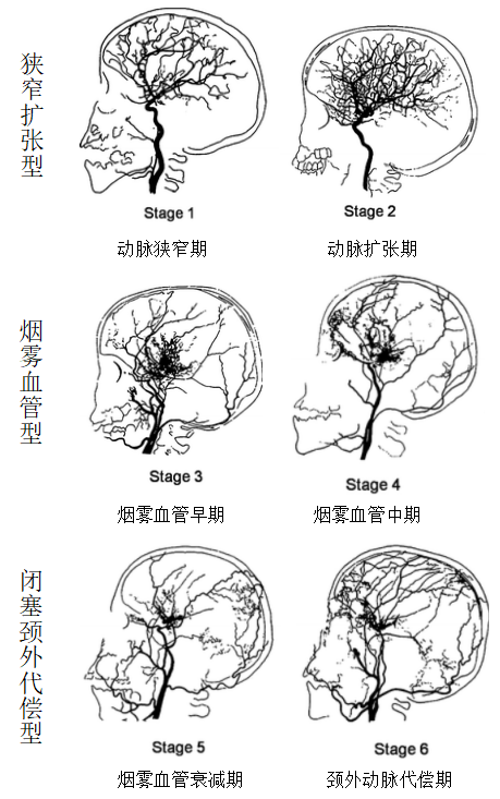 煙霧病Suzuki分期/分型
