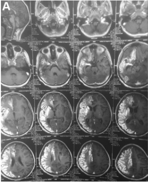 圖1術(shù)前腦MRI（A）顯示右側(cè)大腦中動脈和右側(cè)大腦前動脈區(qū)域急性缺血。