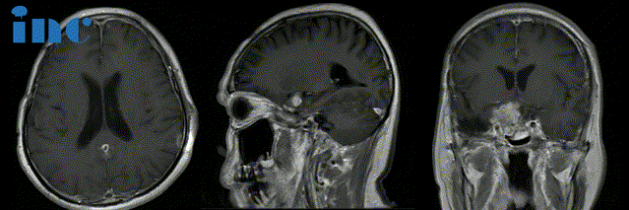 術前MRI