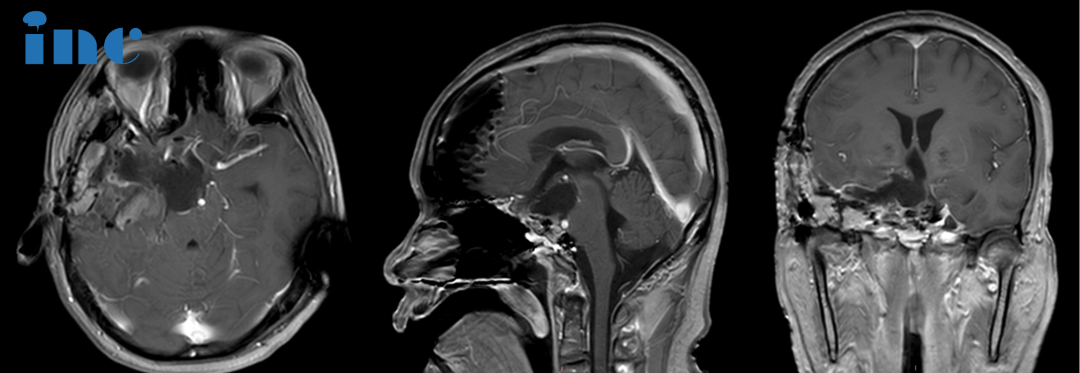 術后：手術順利，術中將鞍上鞍內(nèi)、海綿竇區(qū)、三腦室腫瘤切除