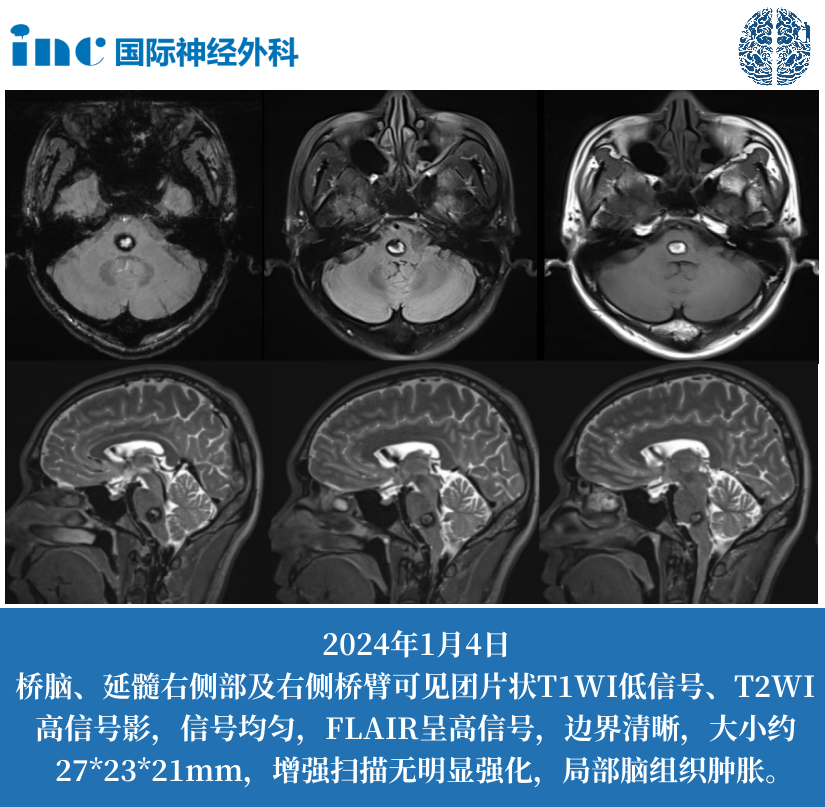 52歲男性-腦干（橋腦）海綿狀血管瘤并出血