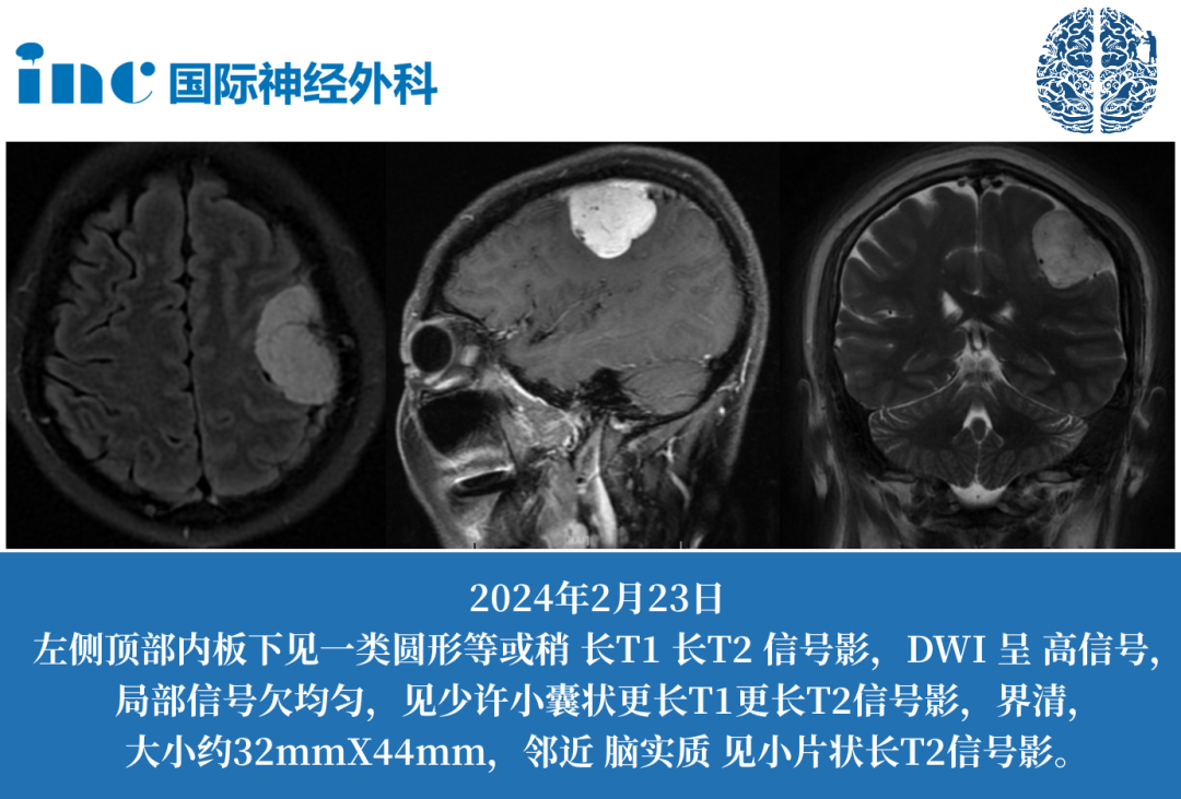 51歲女性——左側(cè)頂葉腦膜瘤