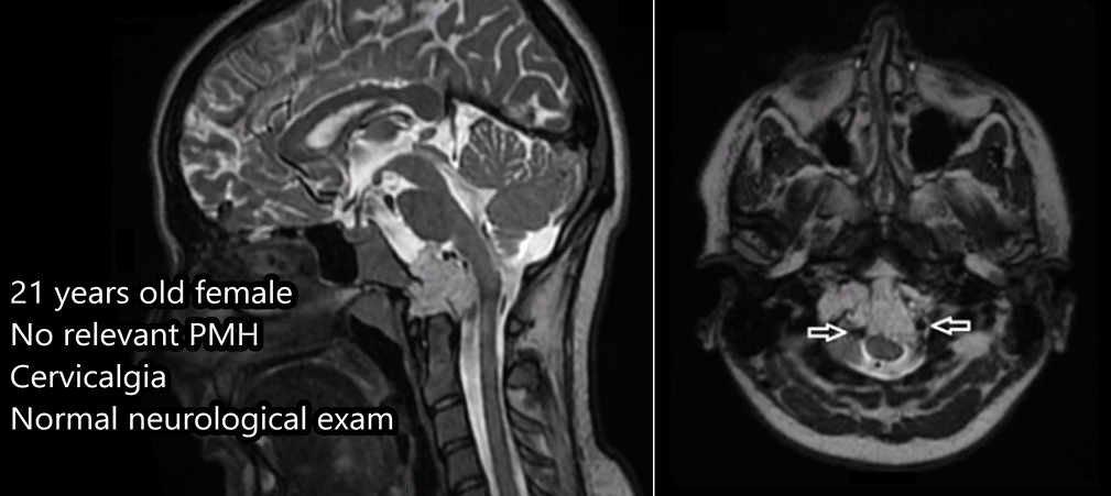 術(shù)前MRI
