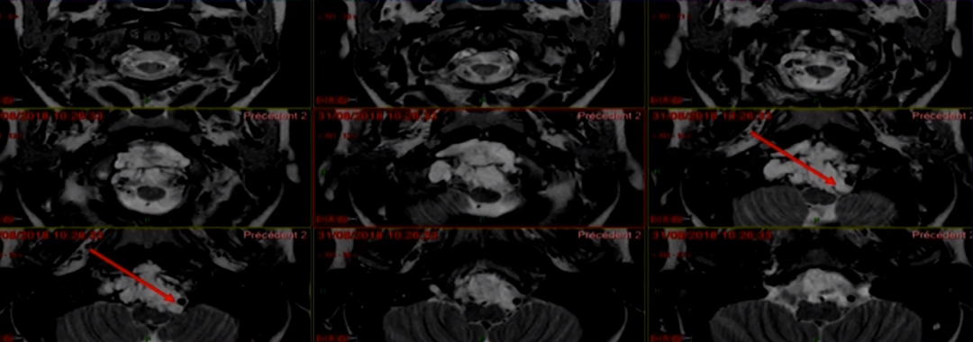 術(shù)前MRI