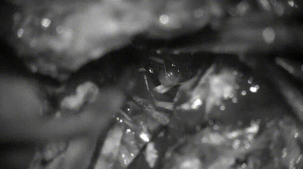 硬膜內(nèi)腫瘤切除，注意將腫瘤從腦干輕輕分離