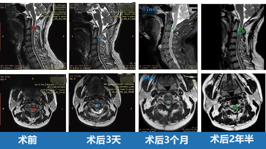 脊髓髓內(nèi)腫瘤真實成功案例——術(shù)前